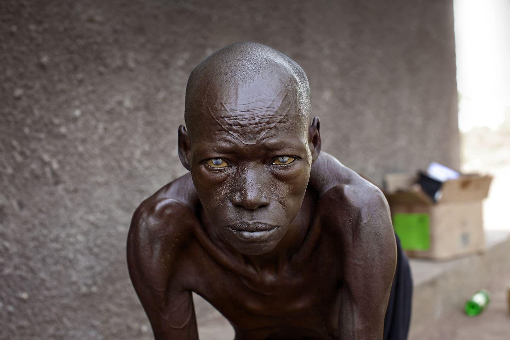 A Kenyan’s Determination To Fight Malnutrition